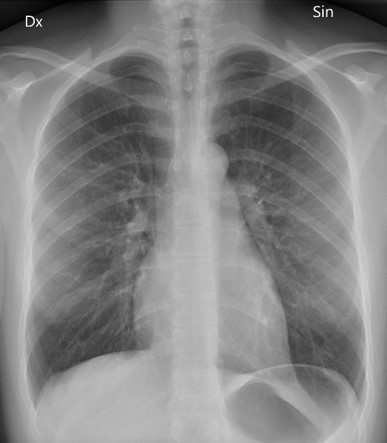 Picture for Pneumonia Detection from Chest X-Rays with Robustness to Deformations