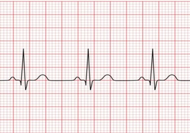 Picture for Classify ECG Time Series Using Wavelet Analysis and Deep Learning