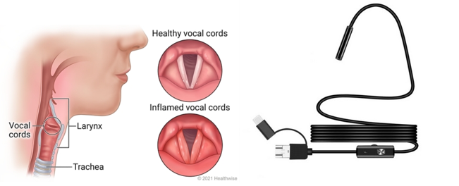 Picture for Video Analysis for Flexible Laryngoscopy
